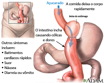 Síndrome de esvaziamento