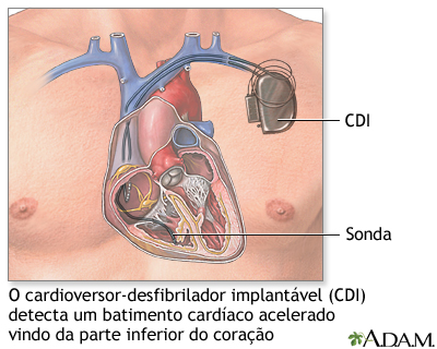 Cardioversor-desfibrilador implantável