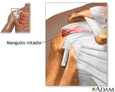 Manguito rotador lesionado