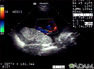 Ultrassom, em cores - cordão umbilical normal