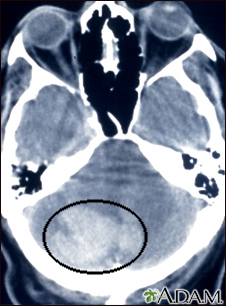 Hemorragia intracerebelar - tomográfica computadorizada