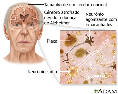 Doença de Alzheimer