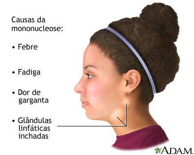 Mononucleose infecciosa