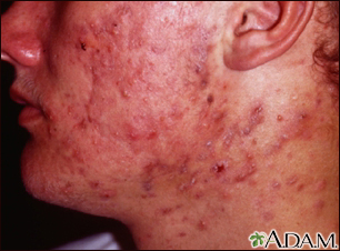 Acne cística no rosto