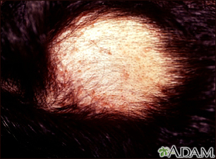 Alopecia areata com pústulas