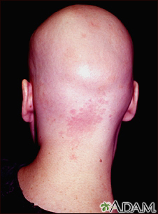 Alopecia totalis - visão posterior da cabeça