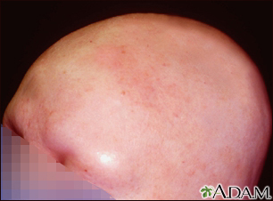 Alopecia totalis - visão frontal da cabeça