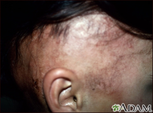 Alopecia, em tratamento