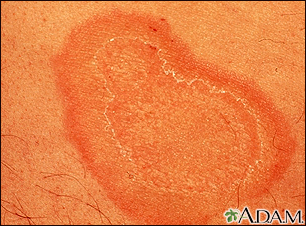 Eritema anular centrífugo - imagem aproximada