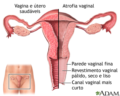 Atrofia vaginal