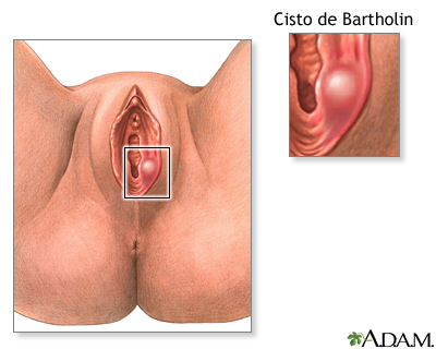 Cisto ou abscesso de Bartholin