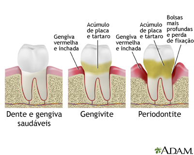 Periodontite