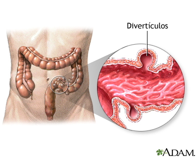 Divertículos