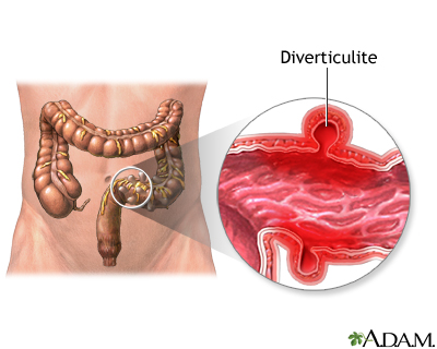 Diverticulite