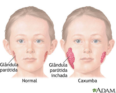 Caxumba (parotidite)