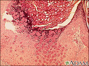 Molusco contagioso, aparência microscópica