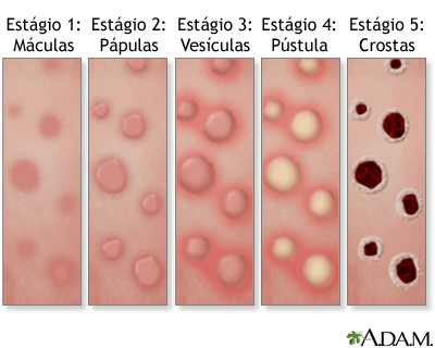 Erupção cutânea da varíola dos macacos