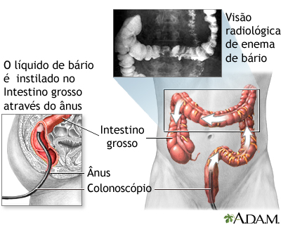 Enema de bário