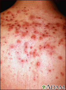 Acne - imagem aproximada de cistos nas costas