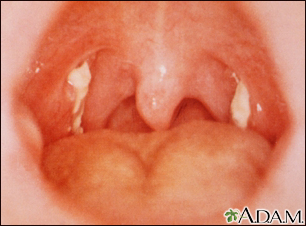 Mononucleose - visualização da garganta