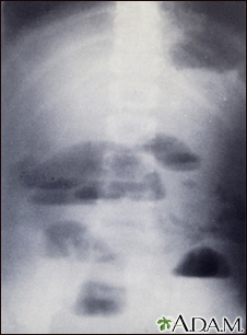 Obstrução do intestino delgado - raio X