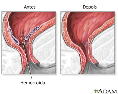 Cuidado após o procedimento