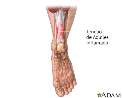 Tendão de Aquiles inflamado