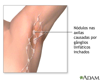 Gânglios linfáticos inchados embaixo dos braços