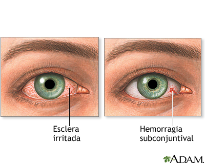 Olhos vermelhos