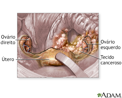 Câncer de ovário