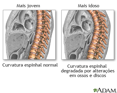 Mudanças na coluna vertebral com a idade