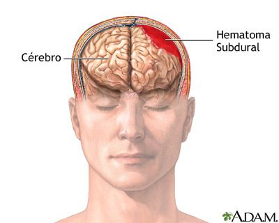 Hematoma subdural