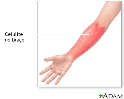 Celulite no braço