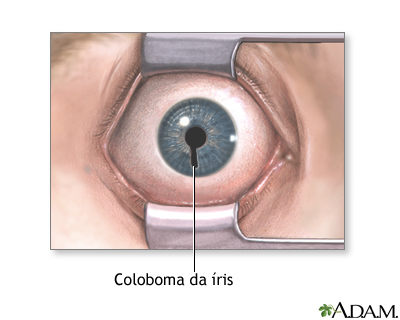 Coloboma da íris