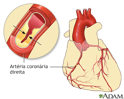 Doença das artérias coronárias