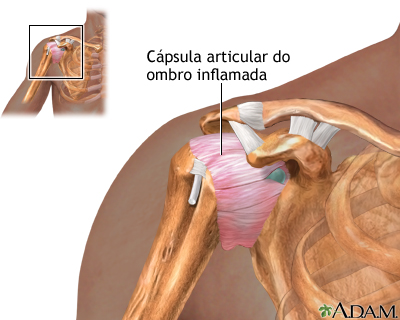 Inflamação na articulação do ombro