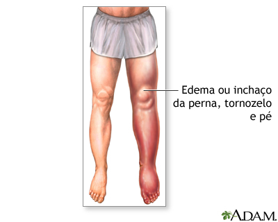 Edema nas pernas