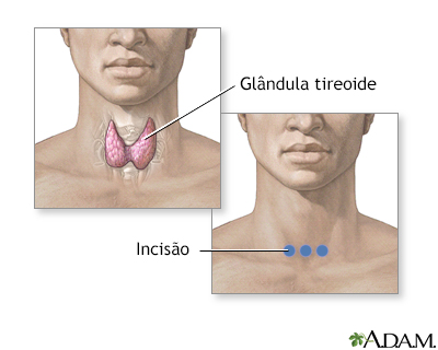 Incisão para cirurgia da glândula tireoide