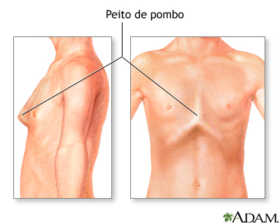 Tórax arqueado (peito de pombo)