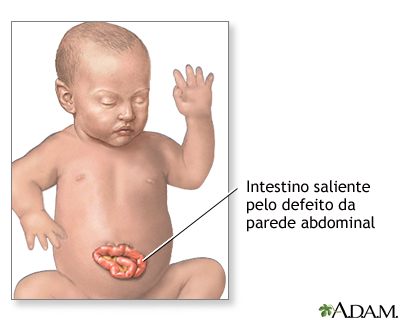 Hérnia abdominal (gastrosquise) em bebês