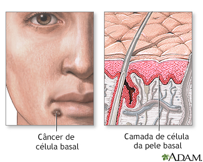 Câncer basocelular