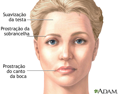 Flacidez facial