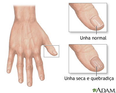 Unhas frágeis