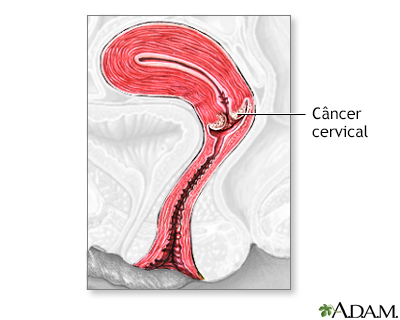 Câncer cervical