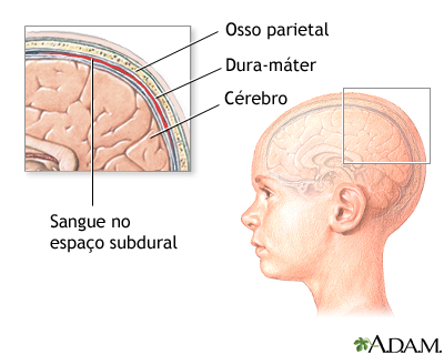 Pressão intracraniana aumentada