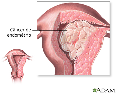 Câncer de endométrio