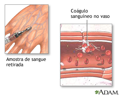 Coágulos de sangue