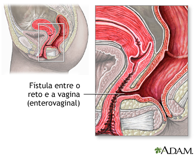 Fístula