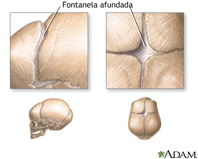 Fontanelas afundadas (vista superior)