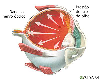 Glaucoma